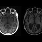 maladie neurologique étrange jeunes