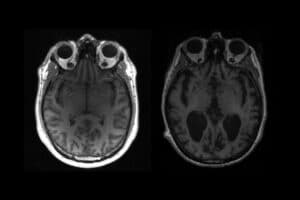 maladie neurologique étrange jeunes